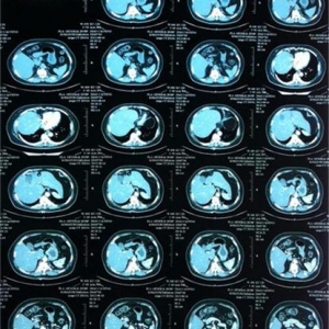 医用CT胶片-激光蓝基胶片